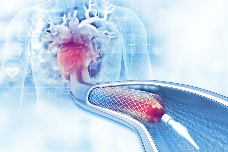 Immagine rappresentativa di angioplastica con ripristino del flusso del sangue al cuore
